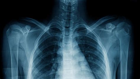 5 Chest X Rays Every Resident Must Master Also Do You Remember The Causes Of White Lung And Types Of Consolidations No Worry Not Just Scroll Through The Last Post Of