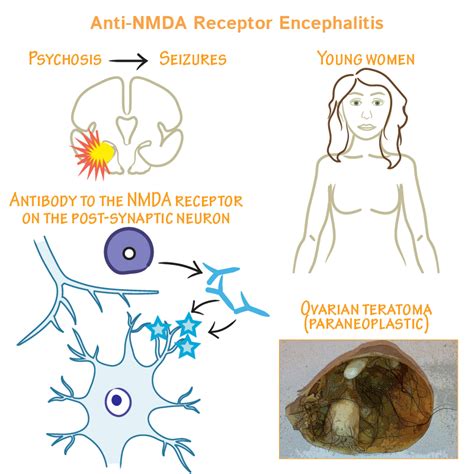 Anti Nmda Receptor Encephalitis A Synopsis