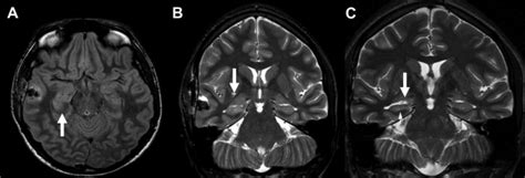 Anti Nmda Receptor Encephalitis Radiology Key