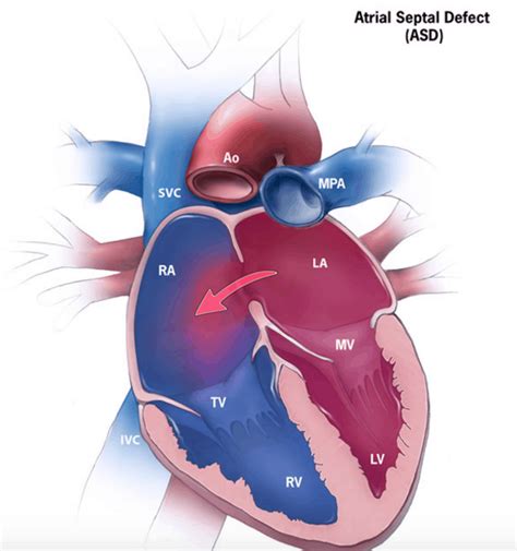 Atrial Septal Defect Asd Symptoms And Causes Penn Medicine