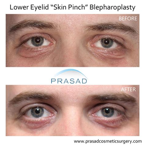 Blepharoplasty Eyebag Droopy Eyelid Transconjunctival Skin Pinch Blepharoplasty Eyebag Droopy Eyelid Transconjunctival Skin Pinch