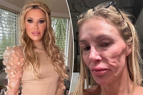Brandi Glanville Reveals Whopping 6 Figure Medical Costs To Treat Mystery Facial Parasite I M Brandi Glanville Reveals Whopping 6 Figure Medical Costs To Treat Mystery Facial Parasite I M