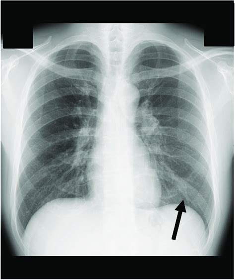 Bronchitis X Ray