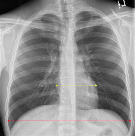 Chest Radiograph Saem