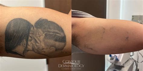 Color Tattoos On Dark Skin Removery