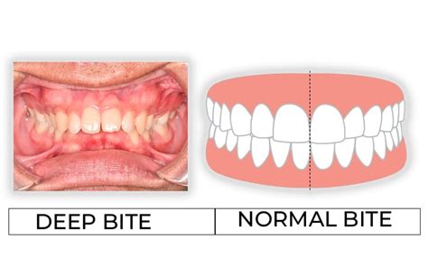 Deep Bite Correction Treatment Options In Scottsdale Az