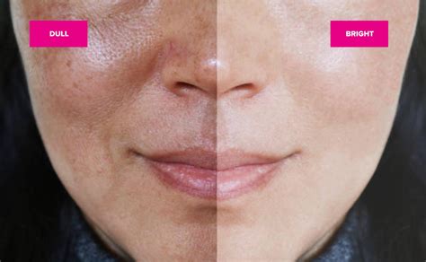 Do You Have Dull Skin Texture Issues Maskne Extra Pigment 5 Skincare Tips To Try Now