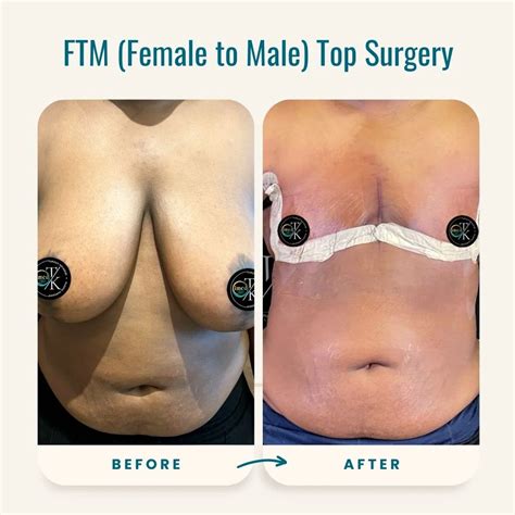 Ftm Top Surgery Results View Top Surgery Results
