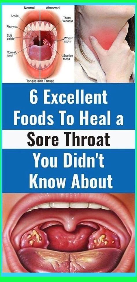 How To Heal Throat After Radiation At Beverly Wesson Blog How To Heal Throat After Radiation At Beverly Wesson Blog