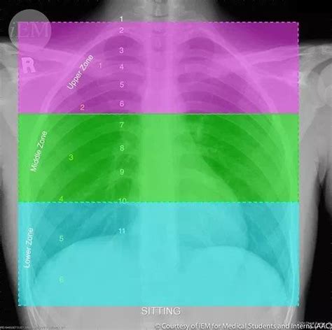 How To Read Chest X Rays International Emergency Medicine Education Project