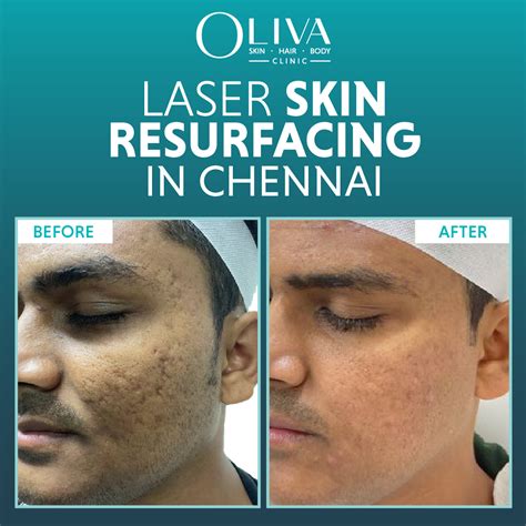Laser Scar And Stretch Mark Resurfacing Lviv Novosilska Clinic Skin Renewal Laser Scar And Stretch Mark Resurfacing Lviv Novosilska Clinic Skin Renewal