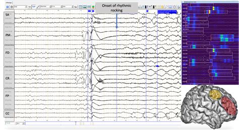 Learn How To Interpret And Use Intracranial Eeg Findings Frauscher 2024 Epileptic Disorders Wiley Online Library Learn How To Interpret And Use Intracranial Eeg Findings Frauscher 2024 Epileptic Disorders Wiley Online Library