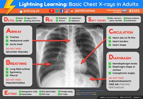 Lightning Learning Basic Chest X Rays In Adults Em3