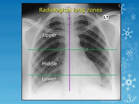 Lung Zone X Ray