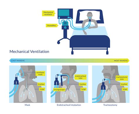 Mechanical Ventilation Oversimplified Nuem Blog Mechanical Ventilation Oversimplified Nuem Blog
