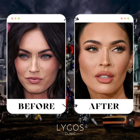 Megan Fox Rhinoplasty Surgery Celebrities Nose Job