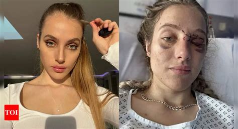 Neuroscientist Turned Onlyfans Model Can T Remember Who She Is After A Near Fatal Bike Accident The Times Of India