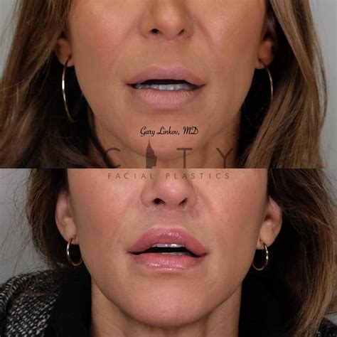 Nyc Lip Lift Revision Surgery Ues Lip Lift Scar Repair Cosmetic Surgery Nyc Lip Lift Revision Surgery Ues Lip Lift Scar Repair Cosmetic Surgery