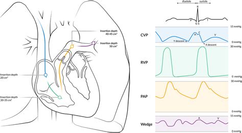 Placement Of The Pac Guided By The Characteristics Of Normal Vascular Download Scientific Diagram Placement Of The Pac Guided By The Characteristics Of Normal Vascular Download Scientific Diagram