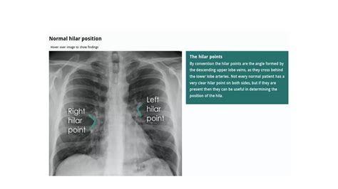 Ppt Chest X Ray