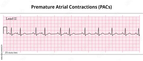 Premature Atrial Contractions Pacs 12 Lead Ecg Resources Acls Certification Association Premature Atrial Contractions Pacs 12 Lead Ecg Resources Acls Certification Association