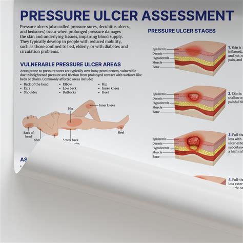 Pressure Ulcer Posterboard