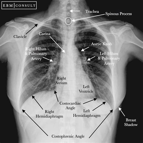 Radiology Thorax Normal