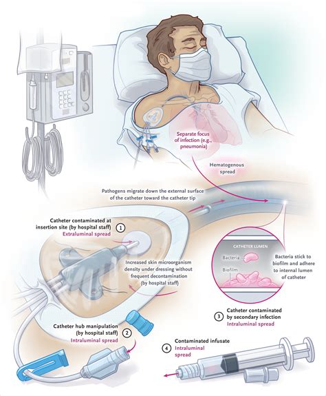 Reducing Central Line Associated Bloodstream Infection Rates Through Education And Bundle Care An Interventional Study In A Dialysis Unit Sciencedirect