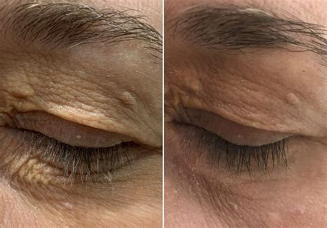 Scar Removal In London Dermasurge On Harley Street Scar Removal In London Dermasurge On Harley Street