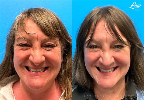 Scar Revision Before After Photos Law Plastic Surgery Scar Revision Before After Photos Law Plastic Surgery