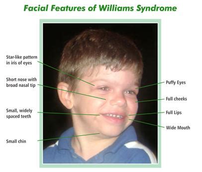 Signs Of William Syndrome William Amp 39 S Syndrome