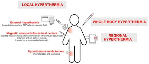 Targeted Hyperthermia Therapy Sona Amp 39 S Cancer Treatment