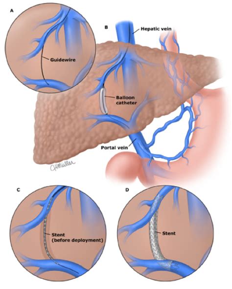 Tip S Ing The Scales Against Portal Hypertension Aasld
