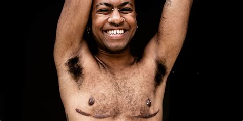 Top Surgery Scars Types Scar Treatments Cover Up Tattoos Ps Beauty