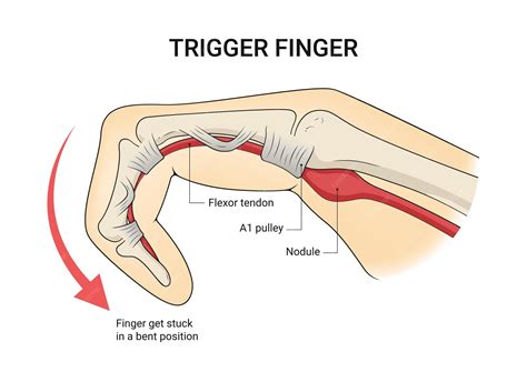 Trigger Finger Emergeortho S Dr Rader Discusses Trigger Finger Causes Symptoms And Treatment Trigger Finger Emergeortho S Dr Rader Discusses Trigger Finger Causes Symptoms And Treatment