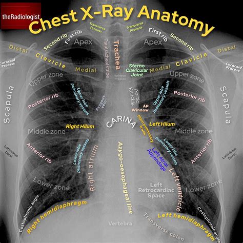 Understanding The Anatomy Of A Normal Chest X Ray