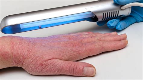 Uv Light Therapy For Eczema At Home Benefits Risks Alternatives Uv Light Therapy For Eczema At Home Benefits Risks Alternatives
