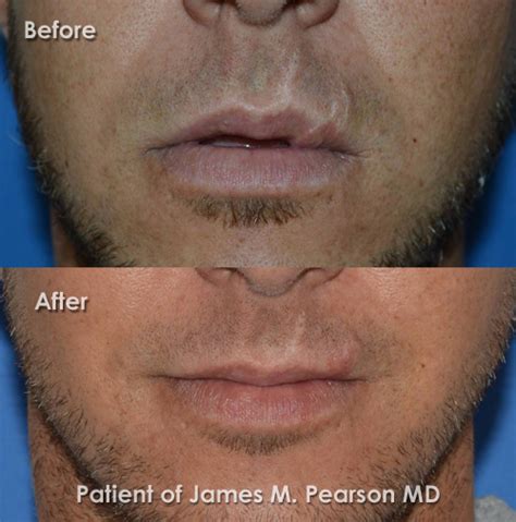 What Are My Options For Lower Lip Scar Removal Revision Photo What Are My Options For Lower Lip Scar Removal Revision Photo