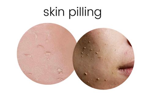 What Is Pilling In Skincare