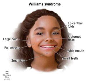 William Syndrome Information Williams Syndrome Family Support Group Victoria Inc