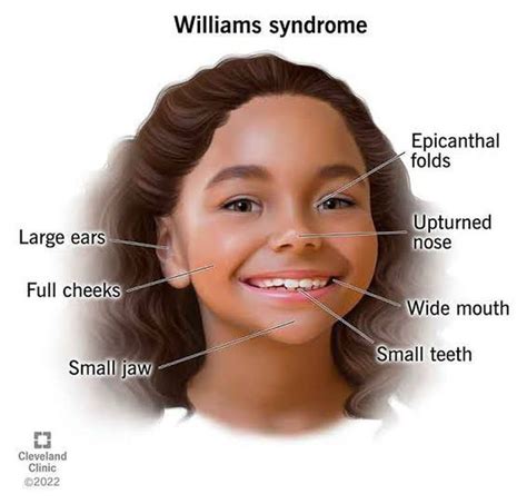 William Syndrome Pedscases