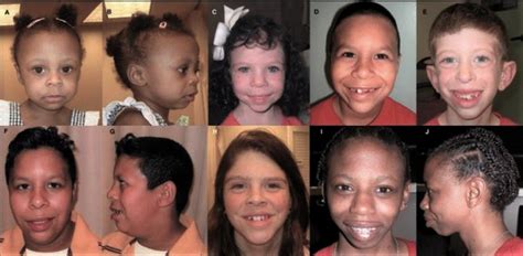 Williams Syndrome Medlineplus Genetics